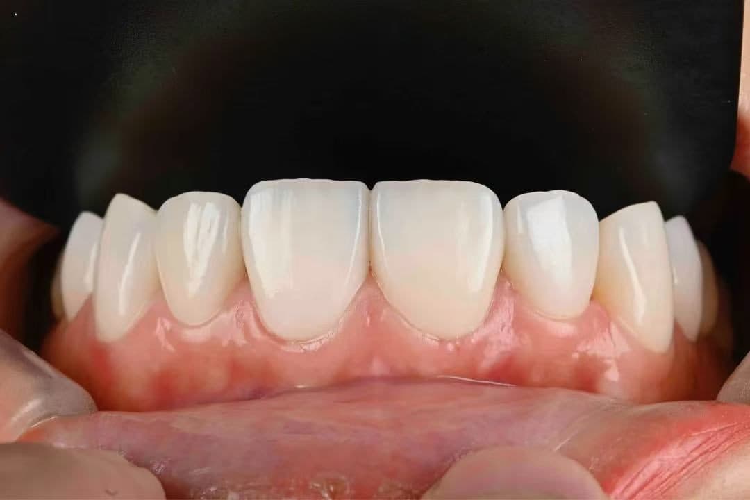 เซรามิกอัดขึ้นรูป IPS e.max / Empress — 5