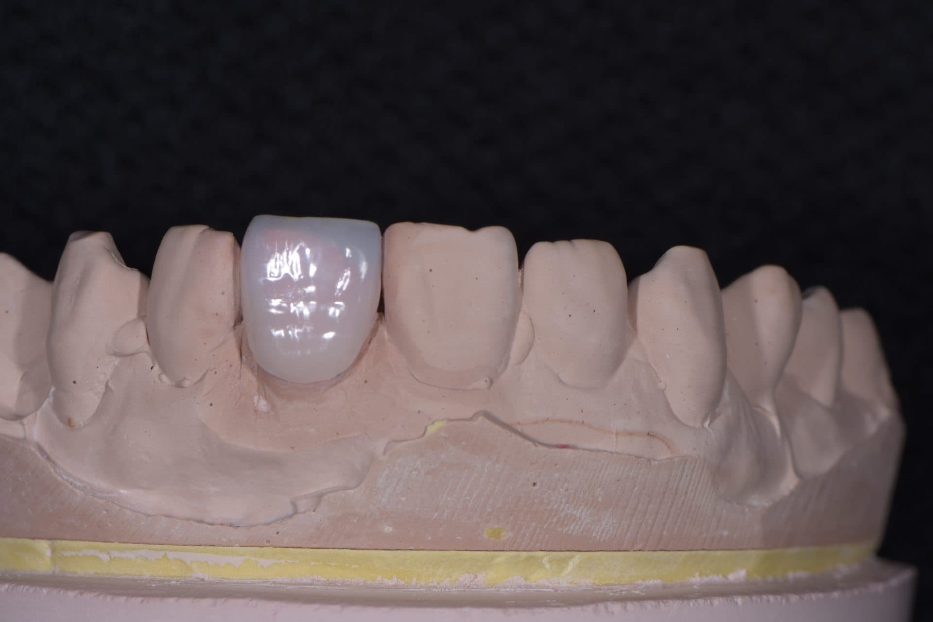 เซรามิกอัดขึ้นรูป IPS e.max / Empress — 6