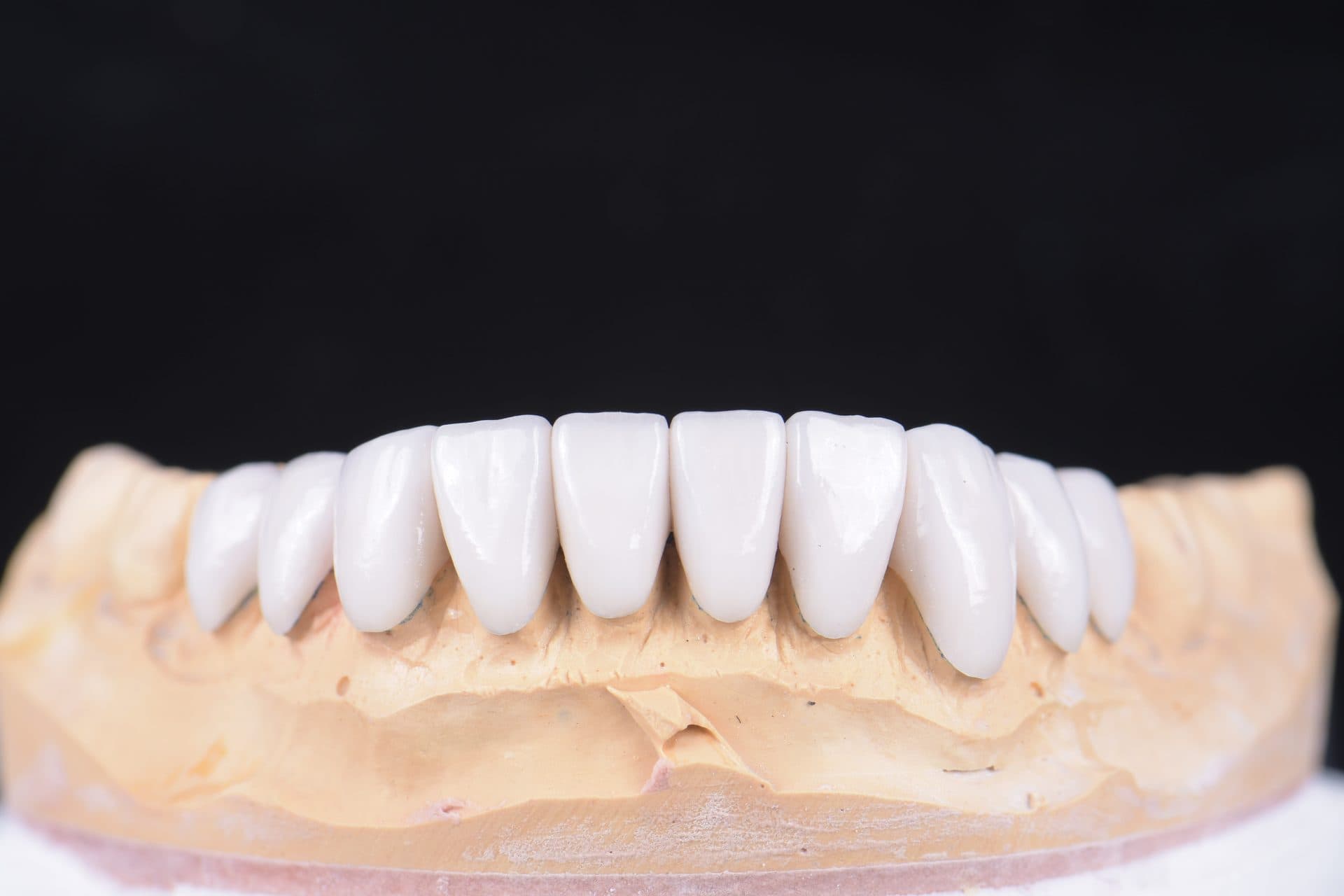 เซรามิกอัดขึ้นรูป IPS e.max / Empress — 9