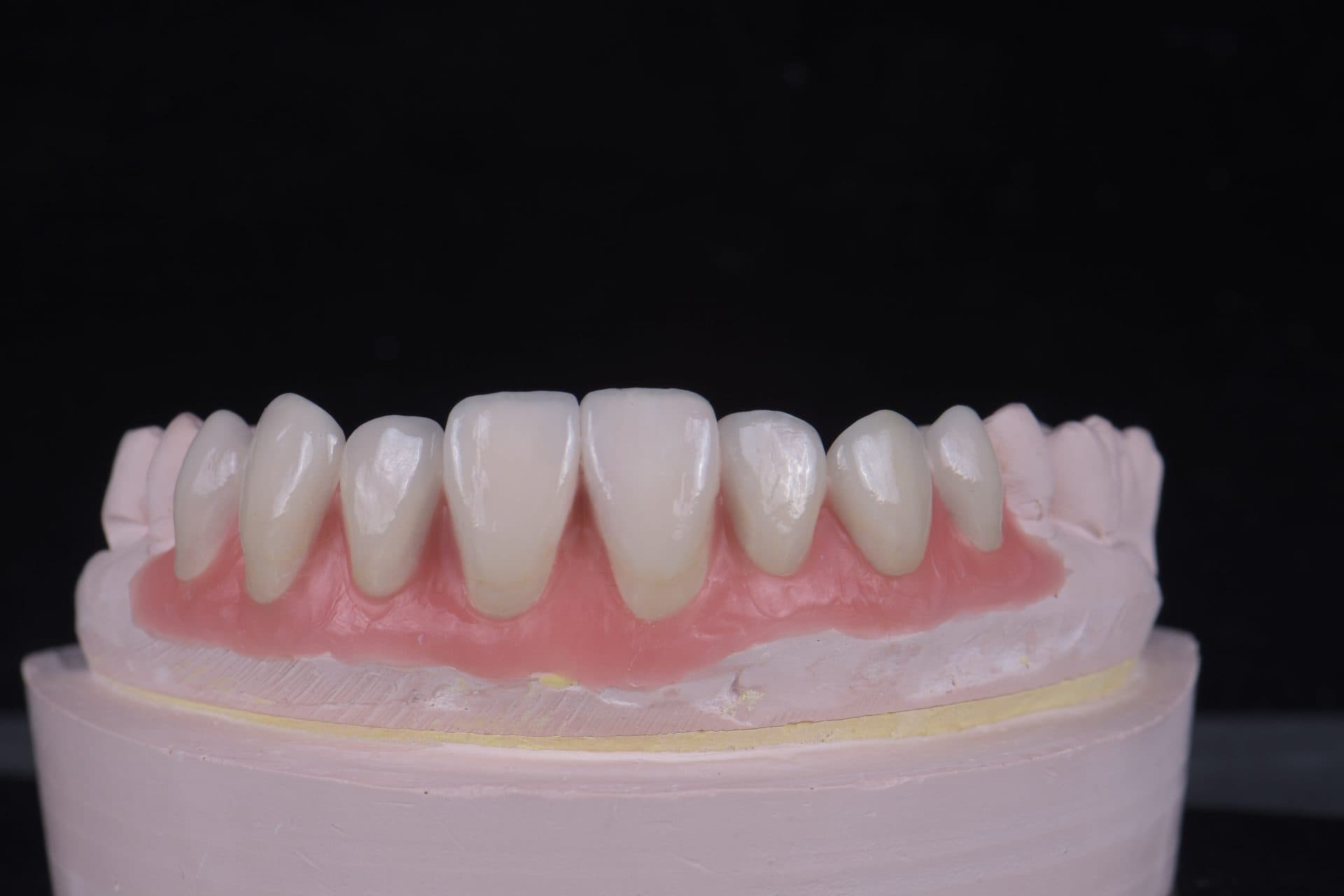 เซรามิกอัดขึ้นรูป IPS e.max / Empress — 12