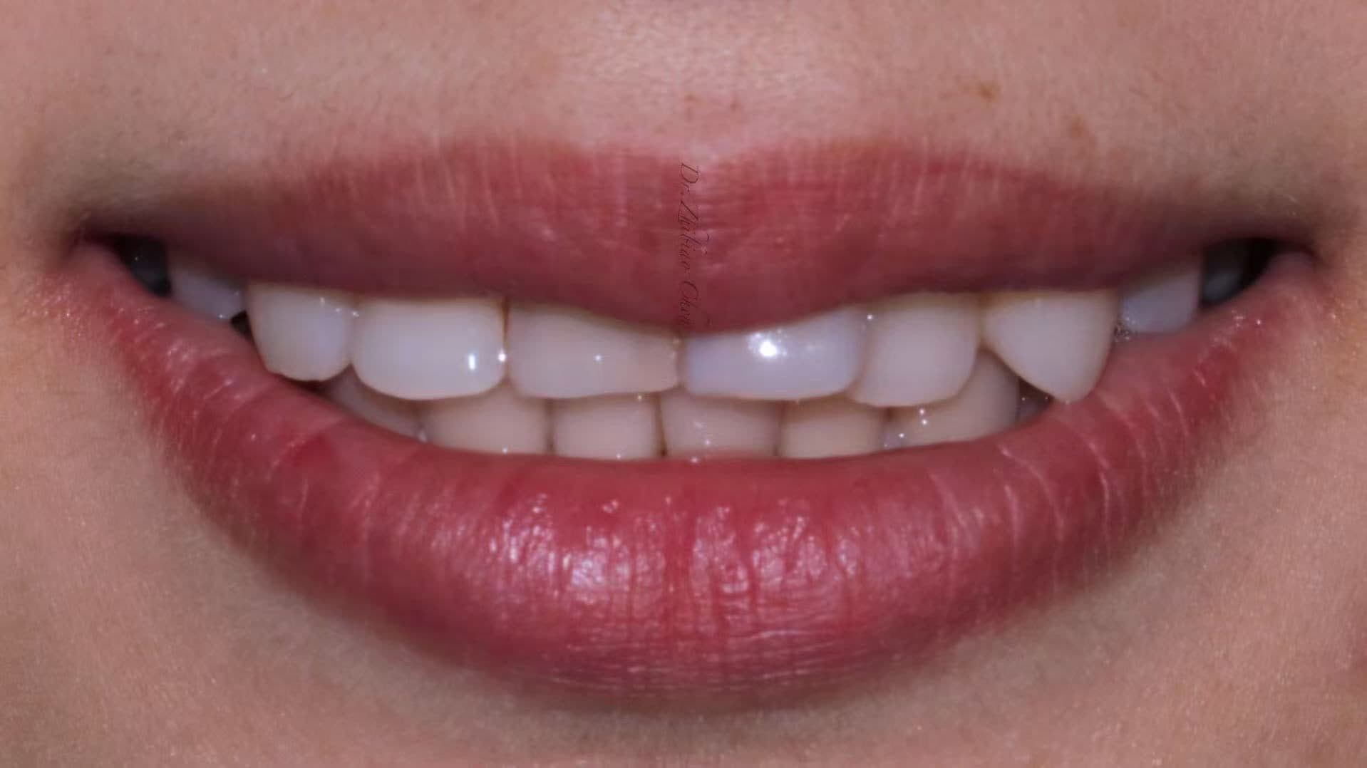 ครอบฟันเซอร์โคเนีย UPCERA (Cibeijian / Jade Porcelain) — 3