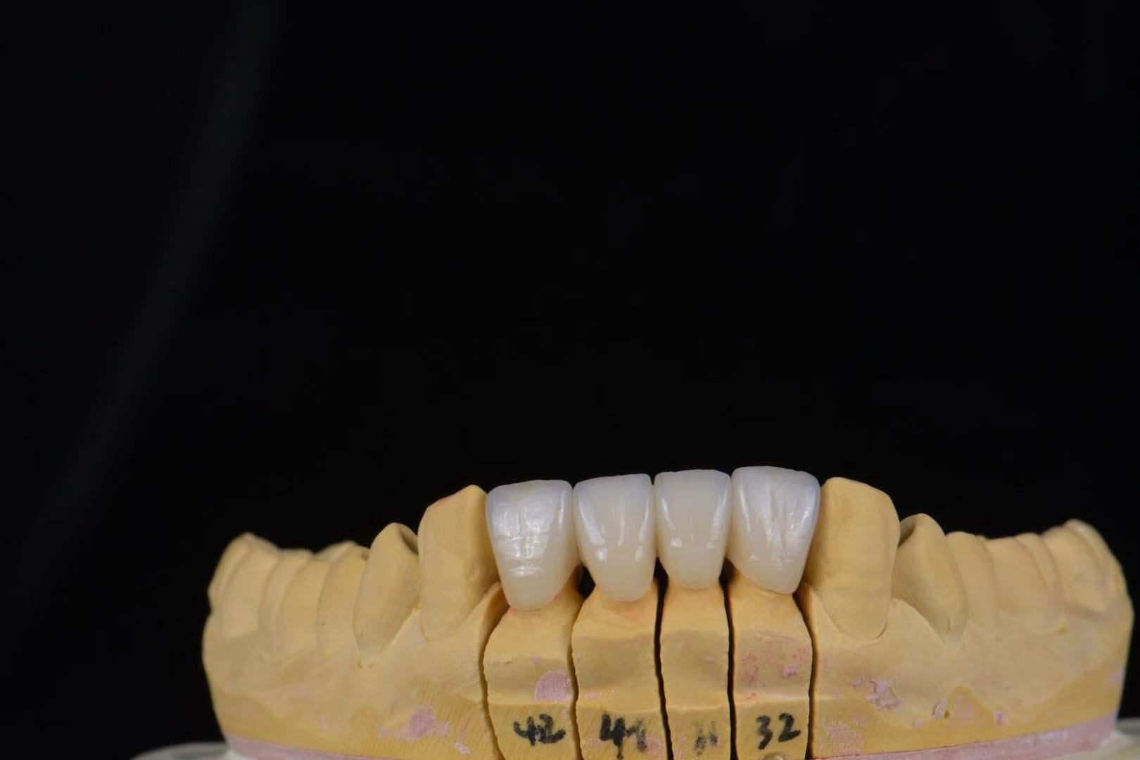 ครอบฟันเซอร์โคเนีย UPCERA (Cibeijian / Jade Porcelain) — 6