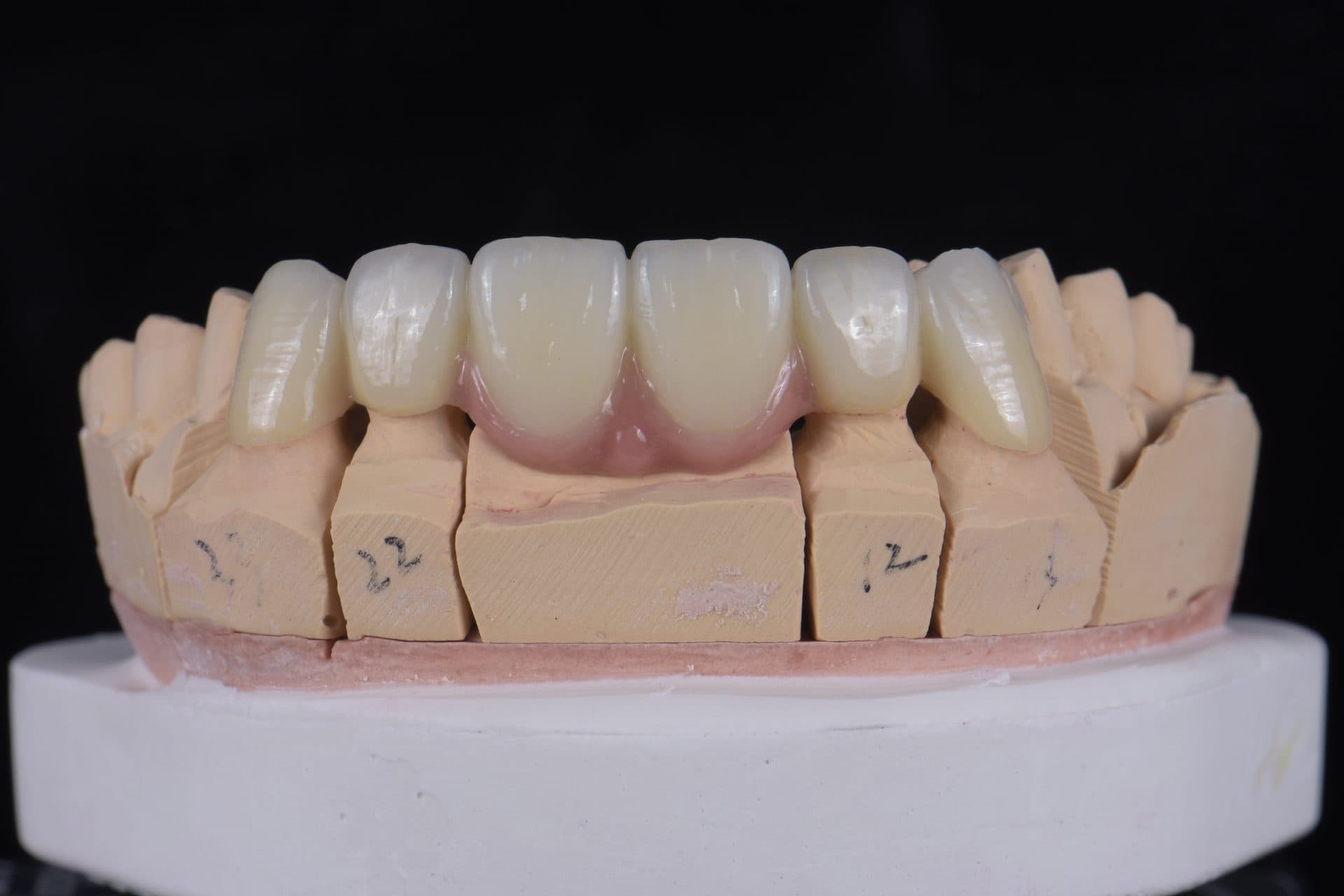 ครอบฟันเซอร์โคเนีย UPCERA (Cibeijian / Jade Porcelain) — 9