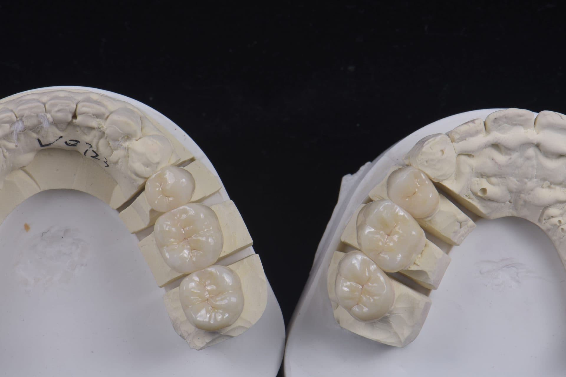 ครอบฟันเซอร์โคเนีย UPCERA (Cibeijian / Jade Porcelain) — 11