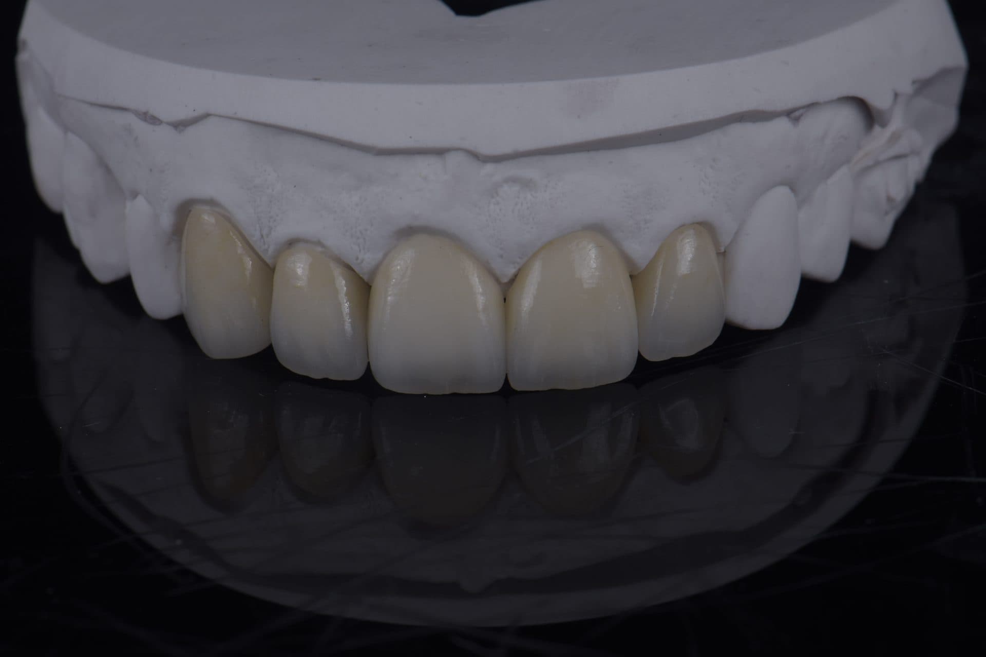 ครอบฟันเซอร์โคเนีย UPCERA (Cibeijian / Jade Porcelain) — 12