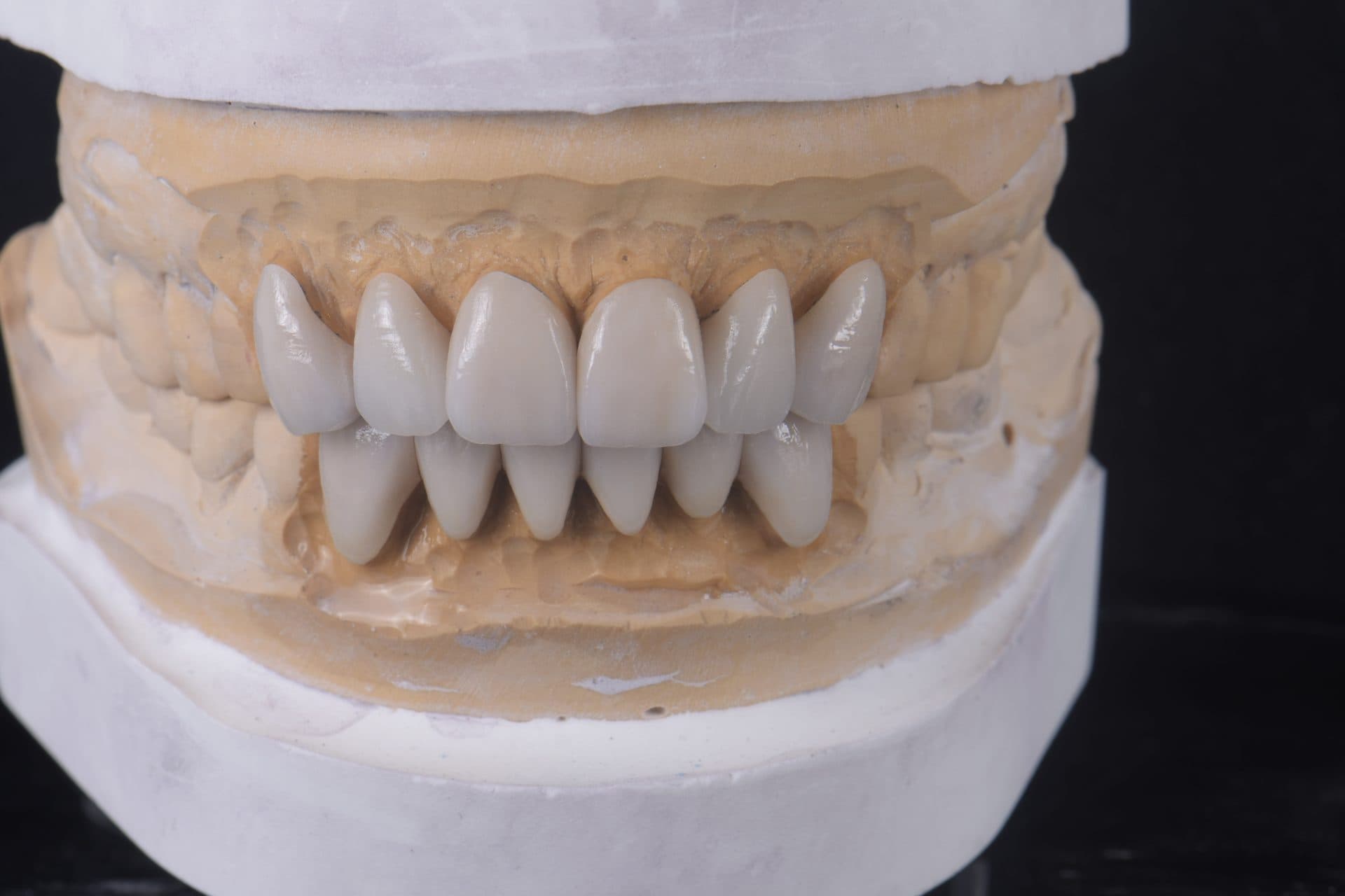 ครอบฟันเซอร์โคเนีย UPCERA (Cibeijian / Jade Porcelain) — 13