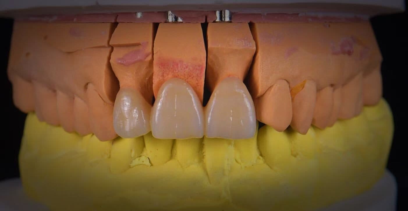 ครอบฟันคอมโพสิตเซรามิก VITA 3D — 1