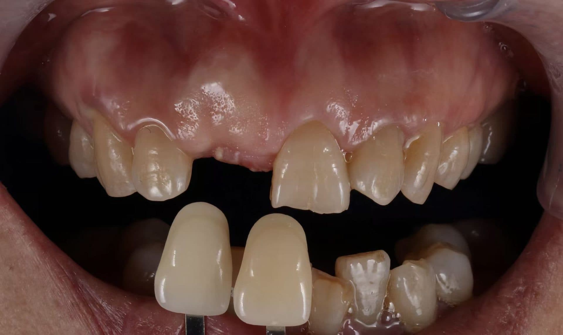 ครอบฟันคอมโพสิตเซรามิก VITA 3D — 2