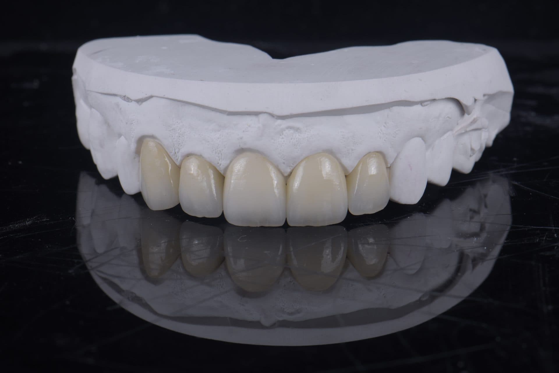 ครอบฟันคอมโพสิตเซรามิก VITA 3D — 4