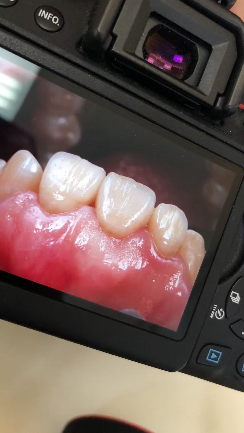 ครอบฟันคอมโพสิตเซรามิก VITA 3D — 5