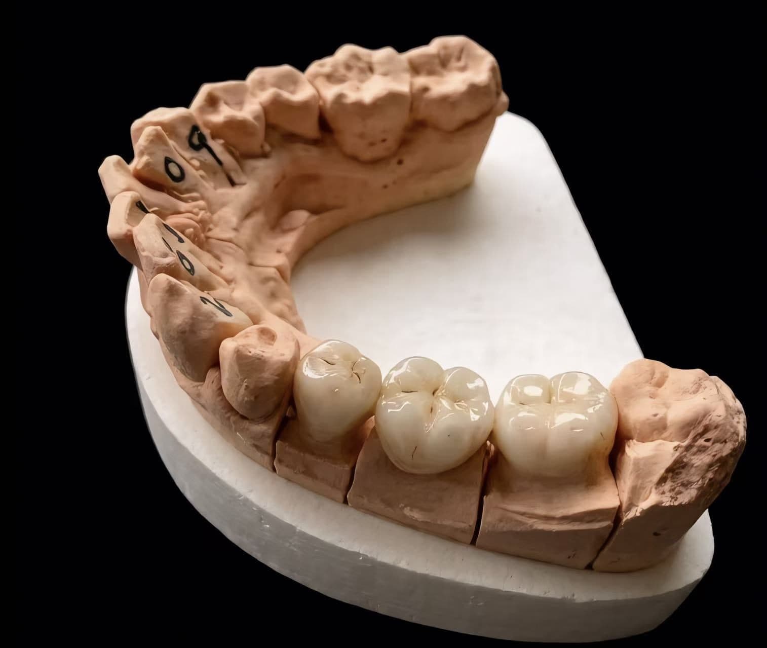 ครอบฟันคอมโพสิตเซรามิก VITA 3D — 6