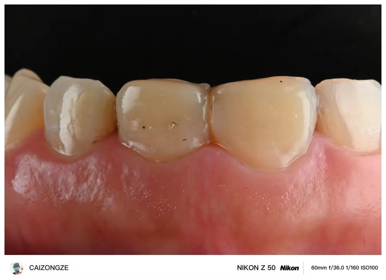 ครอบฟันเซอร์โคเนีย WIELAND Zenostar (เยอรมนี) — 2