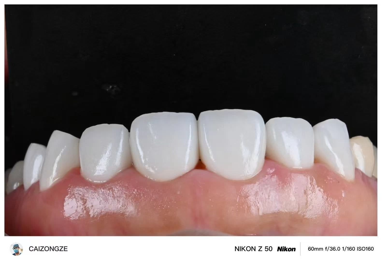 ครอบฟันเซอร์โคเนีย WIELAND Zenostar (เยอรมนี) — 4
