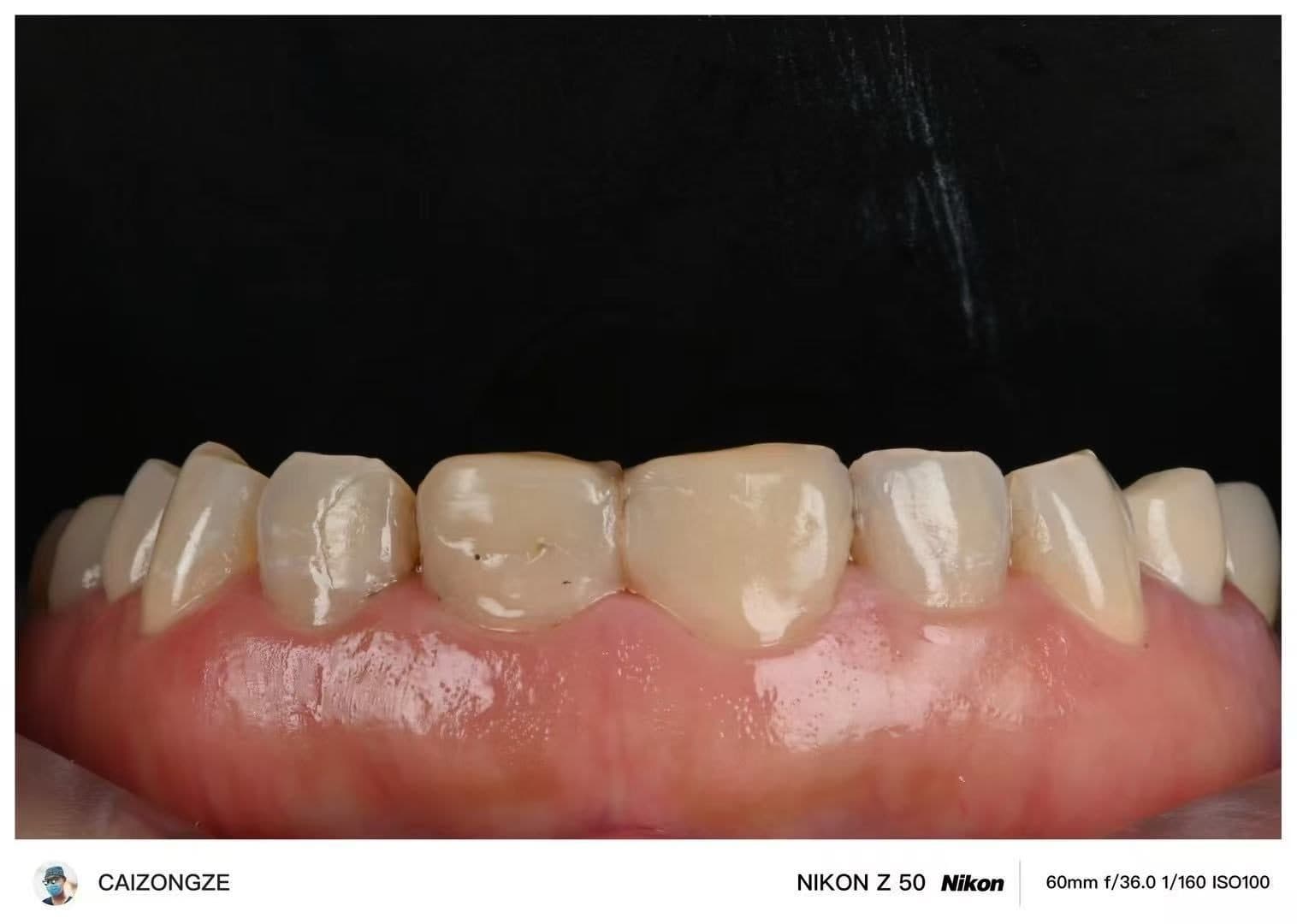 ครอบฟันเซอร์โคเนีย WIELAND Zenostar (เยอรมนี) — 5