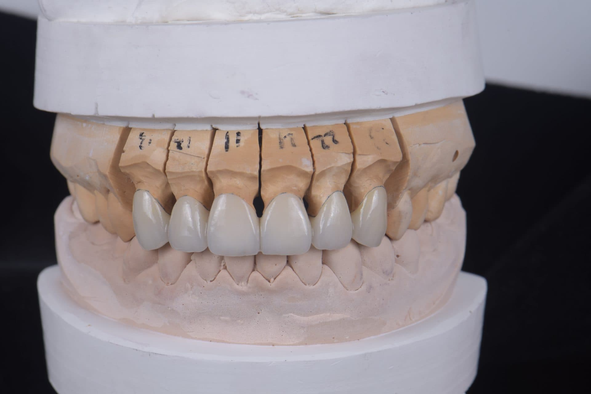 ครอบฟันเซอร์โคเนีย WIELAND Zenostar (เยอรมนี) — 7