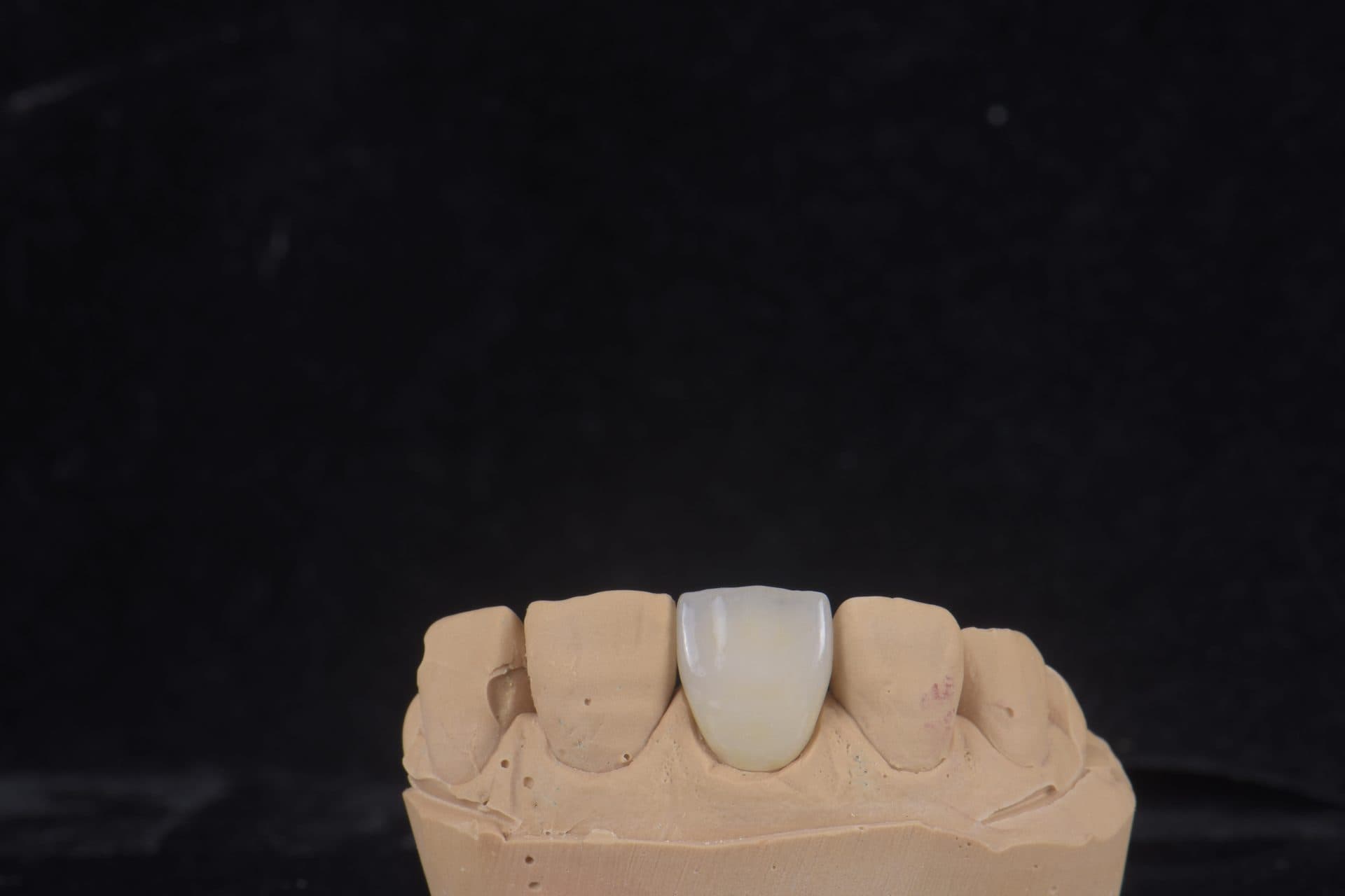 ครอบฟันเซอร์โคเนีย WIELAND Zenostar (เยอรมนี) — 9