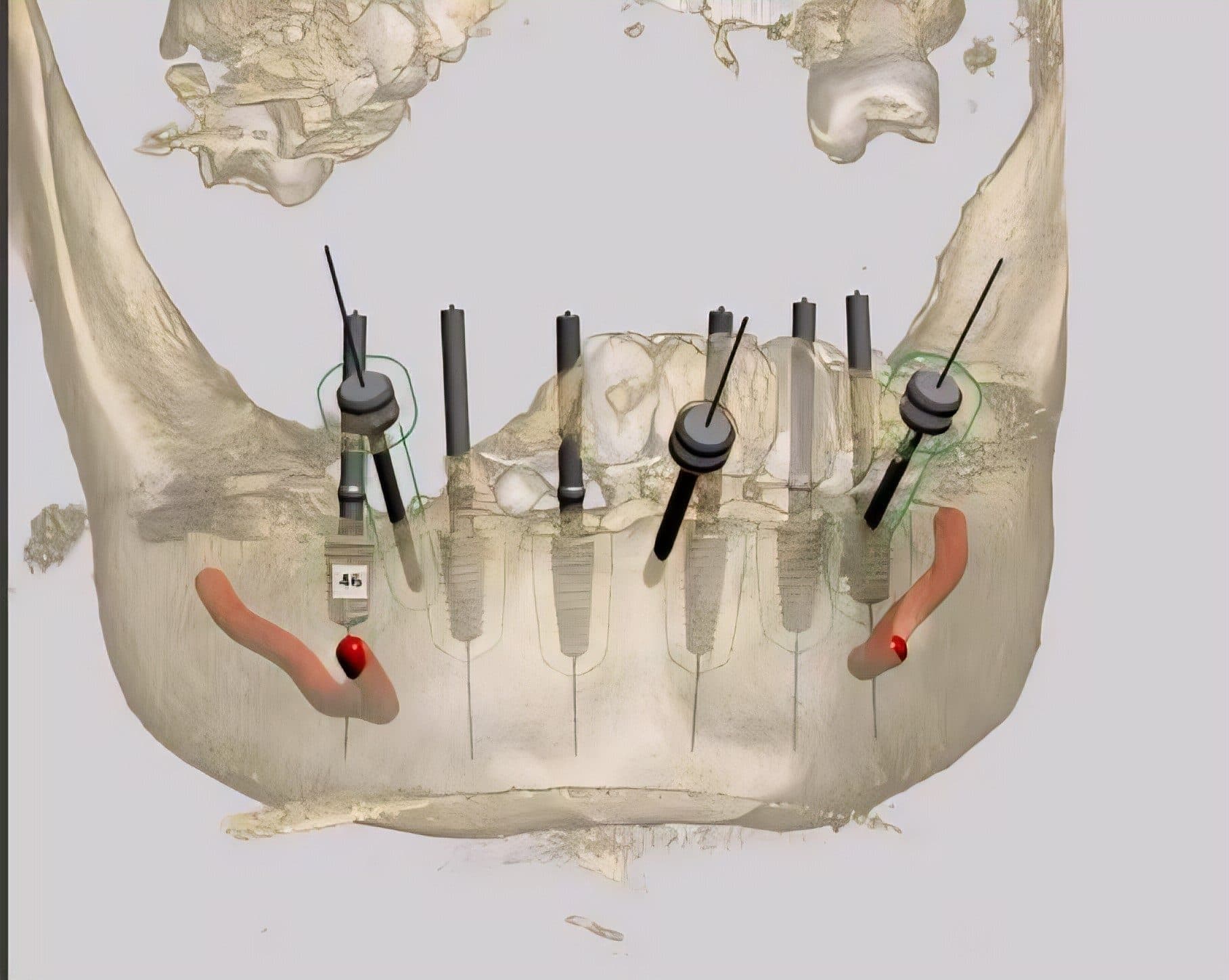 ไกด์ผ่าตัดรากเทียม 3 มิติ จากข้อมูล CBCT — 1