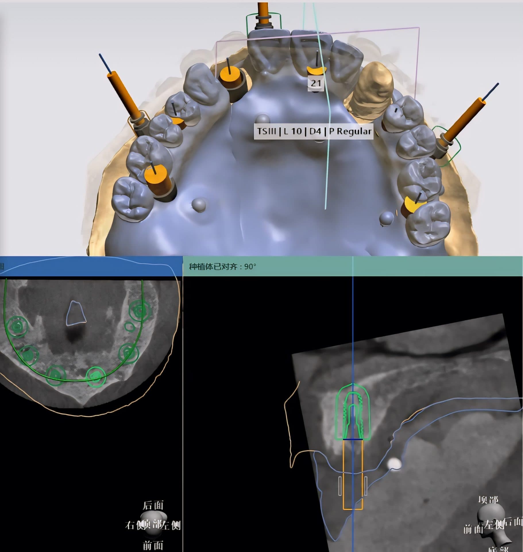 ไกด์ผ่าตัดรากเทียม 3 มิติ จากข้อมูล CBCT — 3