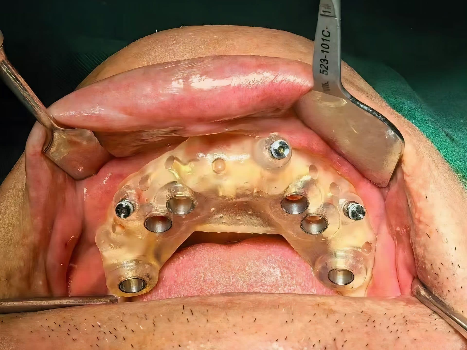 ไกด์ผ่าตัดรากเทียม 3 มิติ จากข้อมูล CBCT — 4