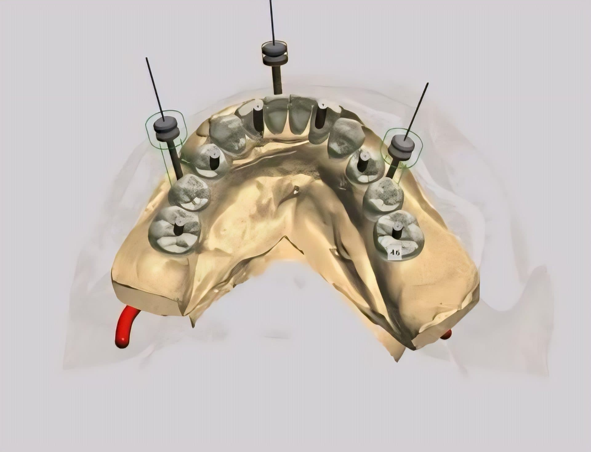 ไกด์ผ่าตัดรากเทียม 3 มิติ จากข้อมูล CBCT — 5