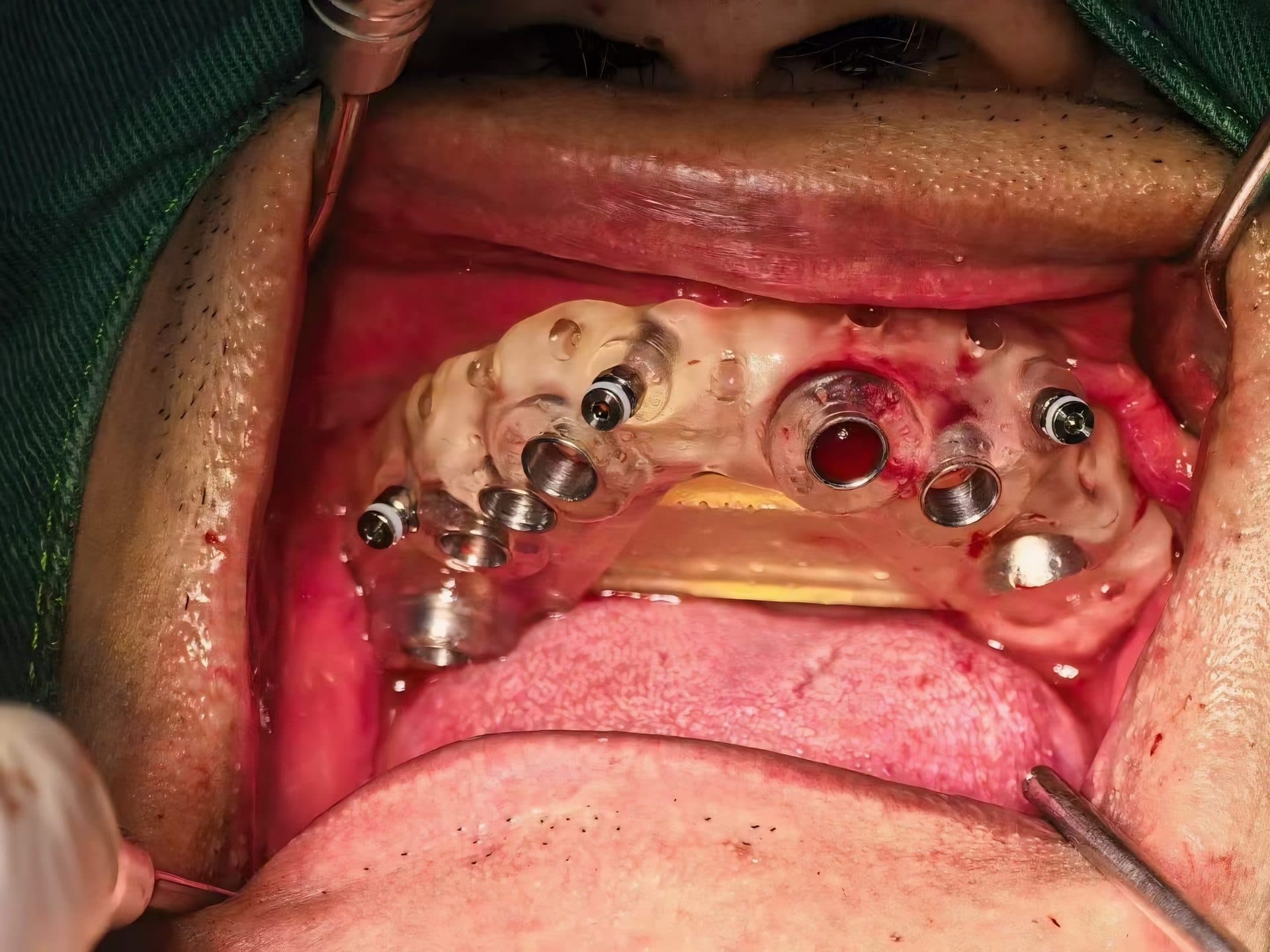 ไกด์ผ่าตัดรากเทียม 3 มิติ จากข้อมูล CBCT — 6